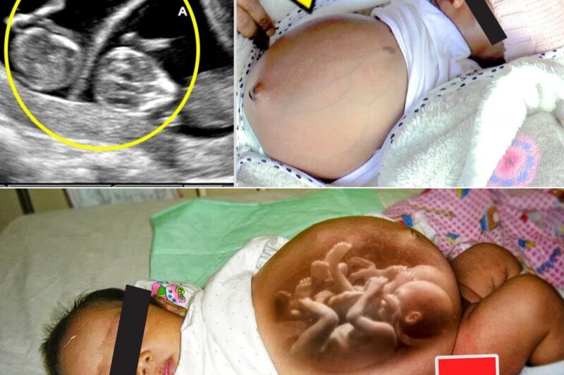 Baby Girl Born Pregnant with Twins and doctors were left speechless!