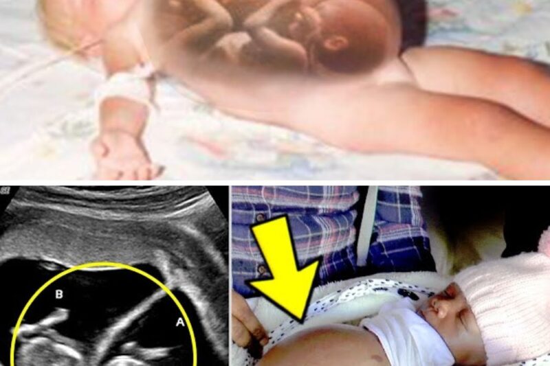 Baby Boy Born Pregnant with Twins and doctors were left speechless!
