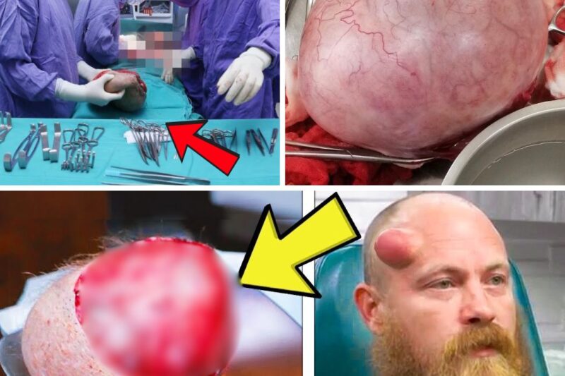 Man Has Huge Head Lump For 20 Years, What He Discovered After Removing It Will Terrify You