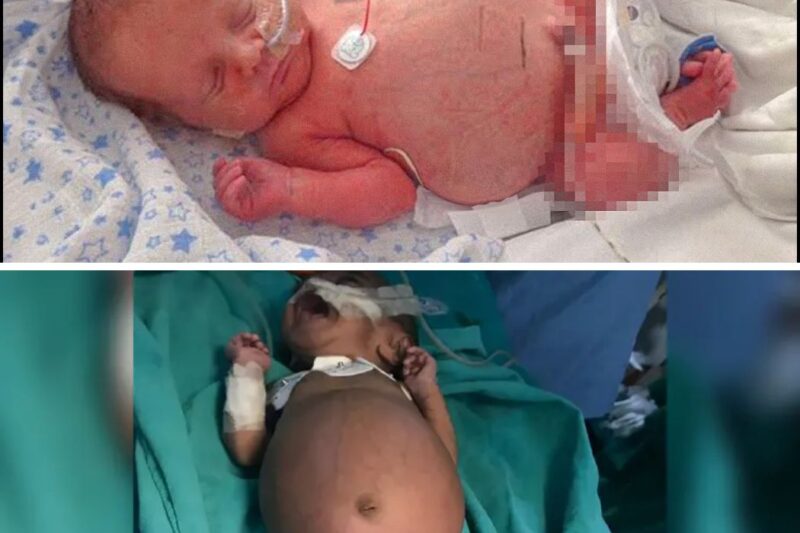 BABY Born with Her Own Twin Growing Inside Her