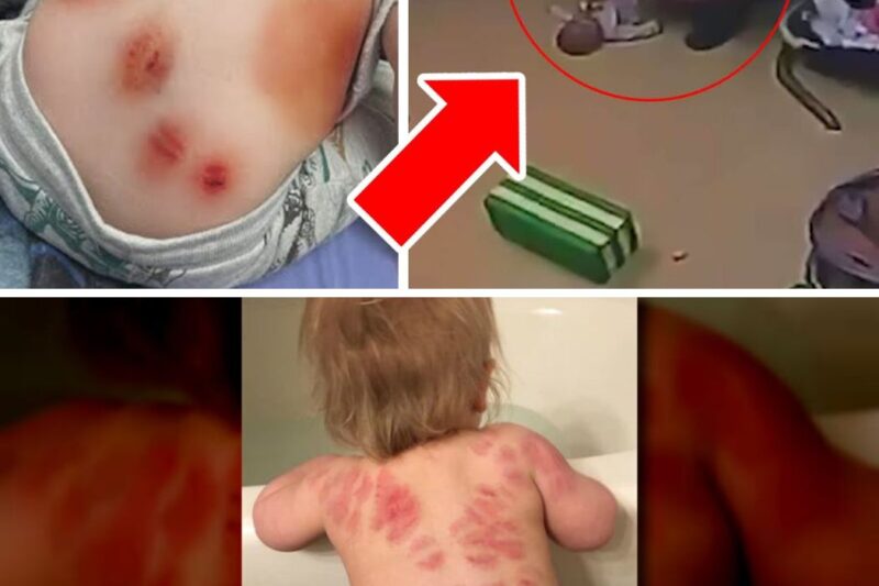 Mom Finds Human BITES on Son’s Back, Daycare Said This…