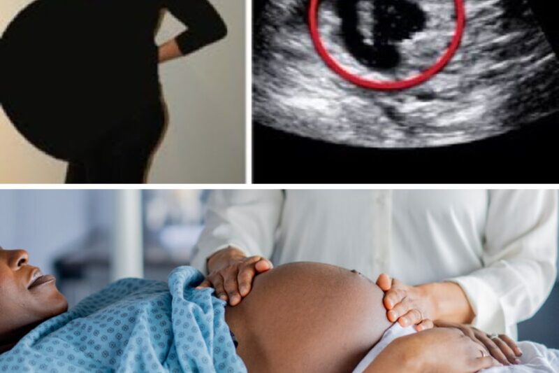 Pregnant Mom Undergoes Emergency C-Section — Doctor Looks into Uterus and Asks, ‘Where’s the Baby?’