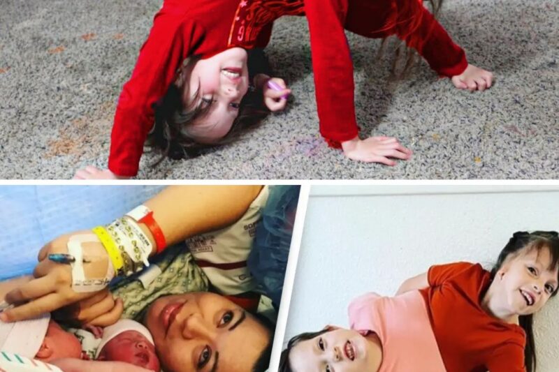 Remember These Conjoined Twins Given 24 Hours to Live? You Won’t Believe What Their Parents Decided!