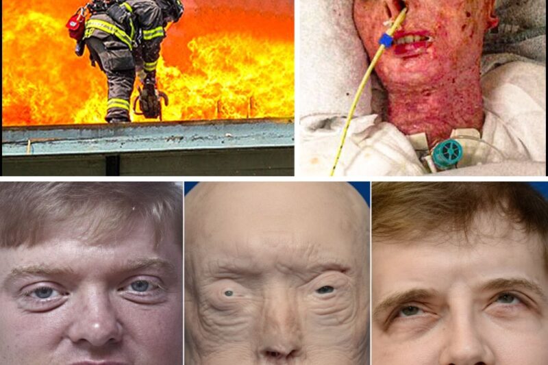 This Firefighter lost his face in fire to save a woman, you won’t believe what he looks like today